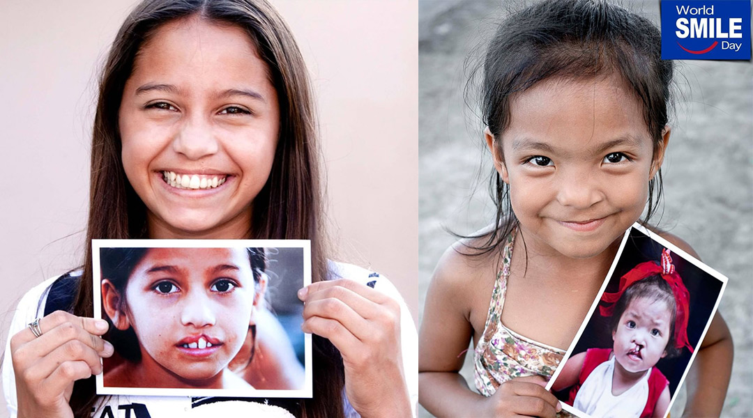 operation smile before and after