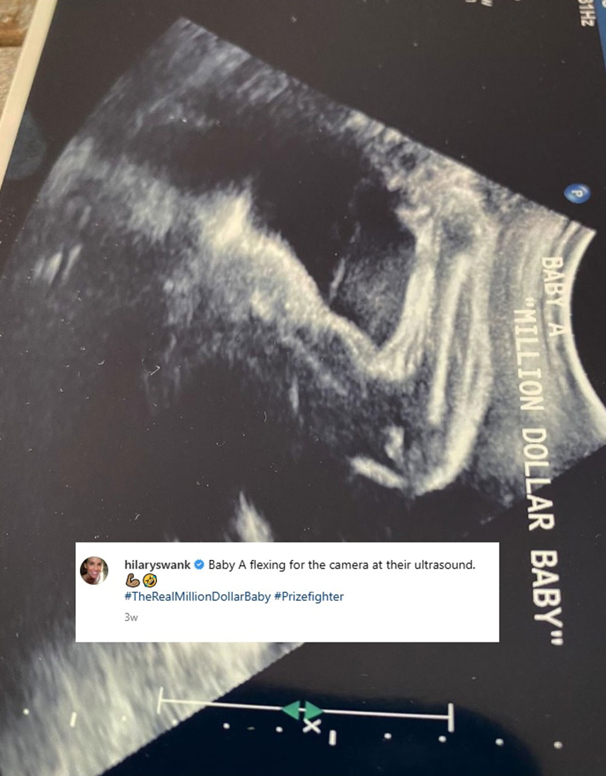 Hillary Swank's ultrasound photo