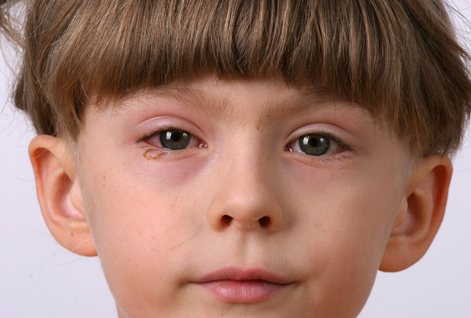 New symptom under the new variant of COVID-19: pink eye/ conjunctivitis