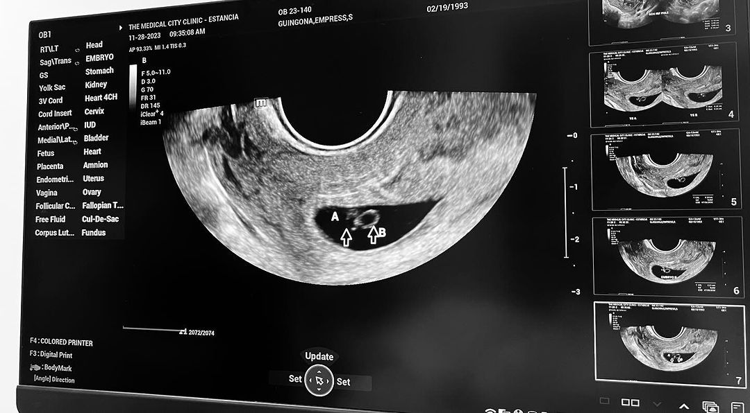 Empress Schuck-Guingona shares a sonogram of her two implanted eggs as she opens up about her miscarriage and the loss of her baby.