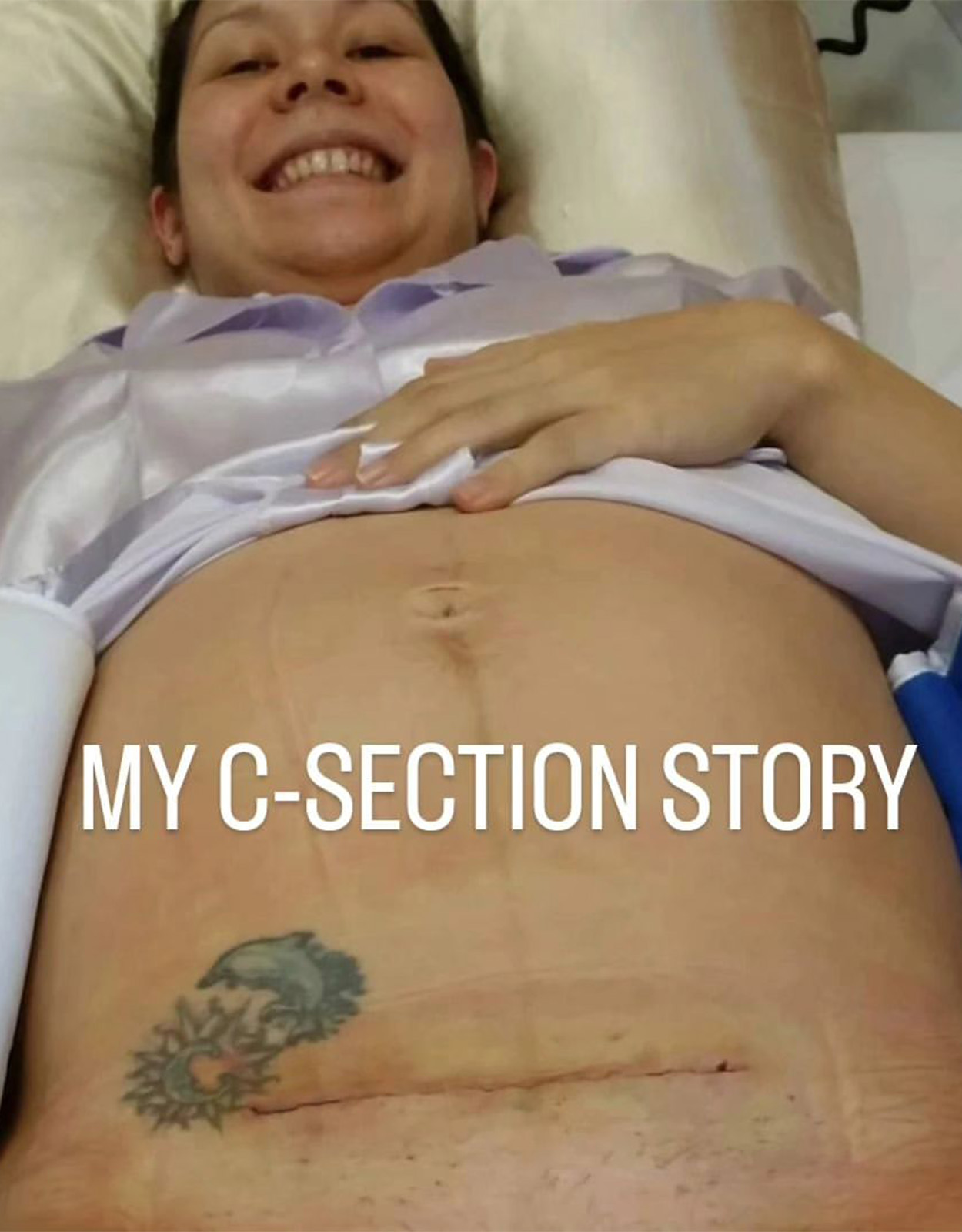 Mindy Lagdameo cesarean story